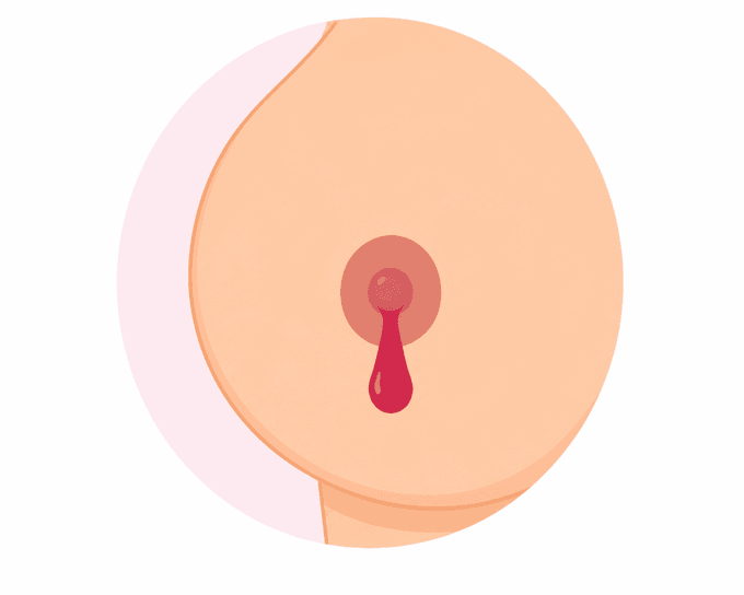 Nipple Discharge